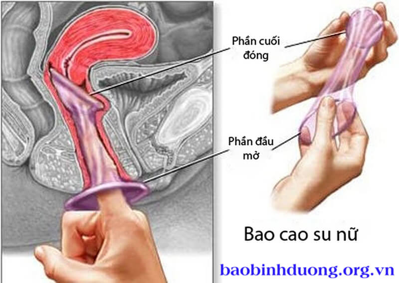 Dùng ngón tay đưa BCS vào sâu âm đạo